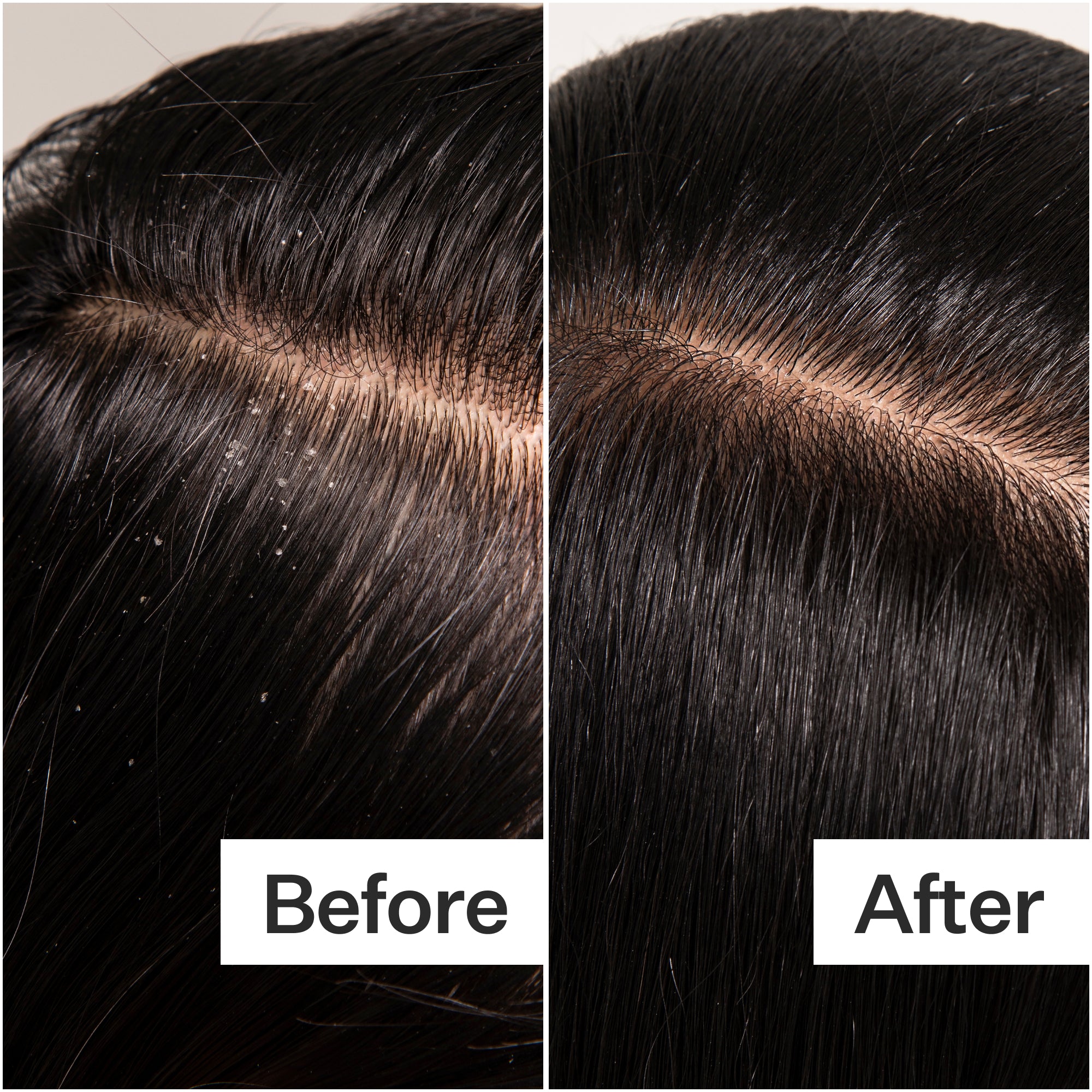 A split image showing hair before and after treatment. The left side has visible flakes, while the right side appears clean and smooth.