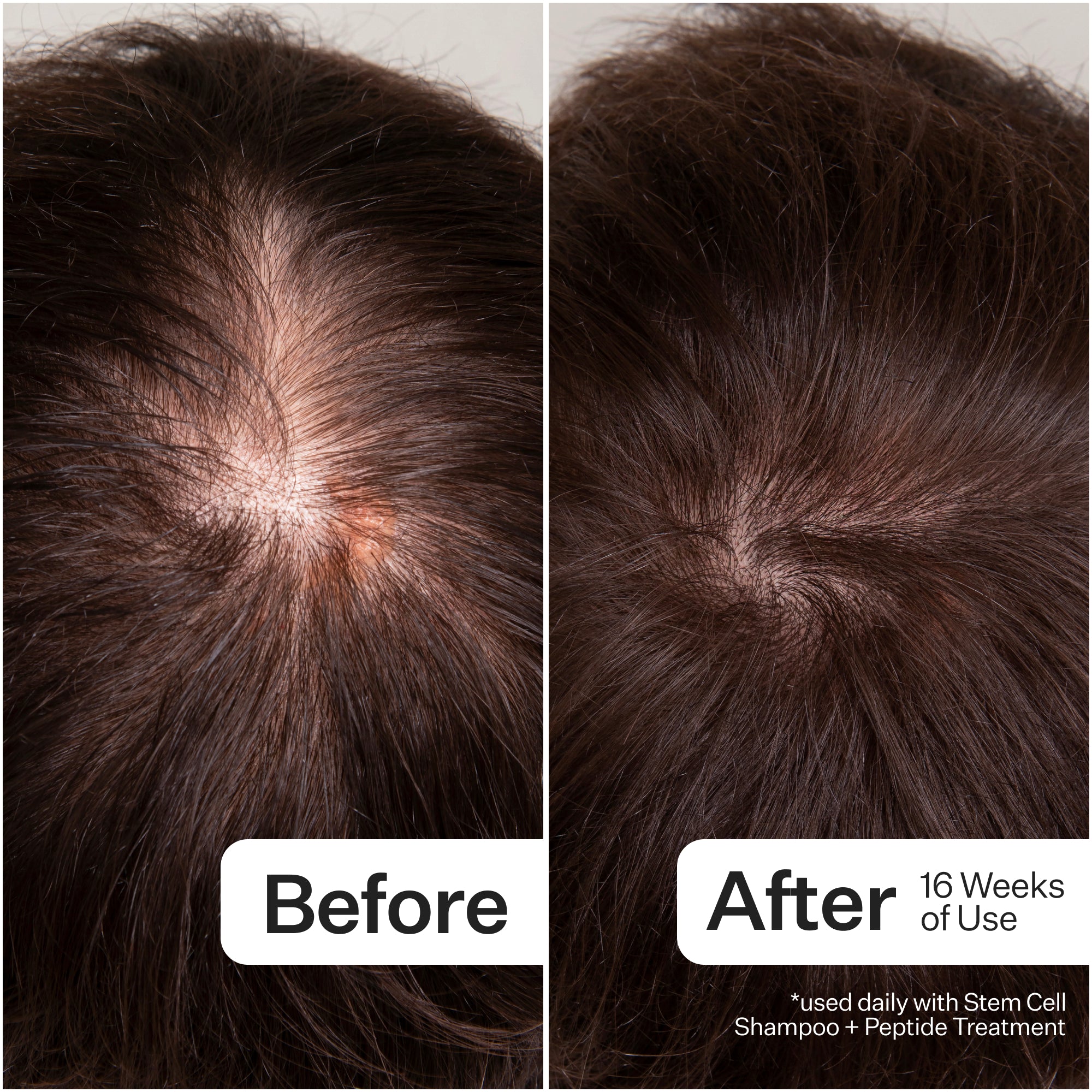 Side-by-side comparison of a scalp before and after 16 weeks of using a hair treatment, showing improved hair density.