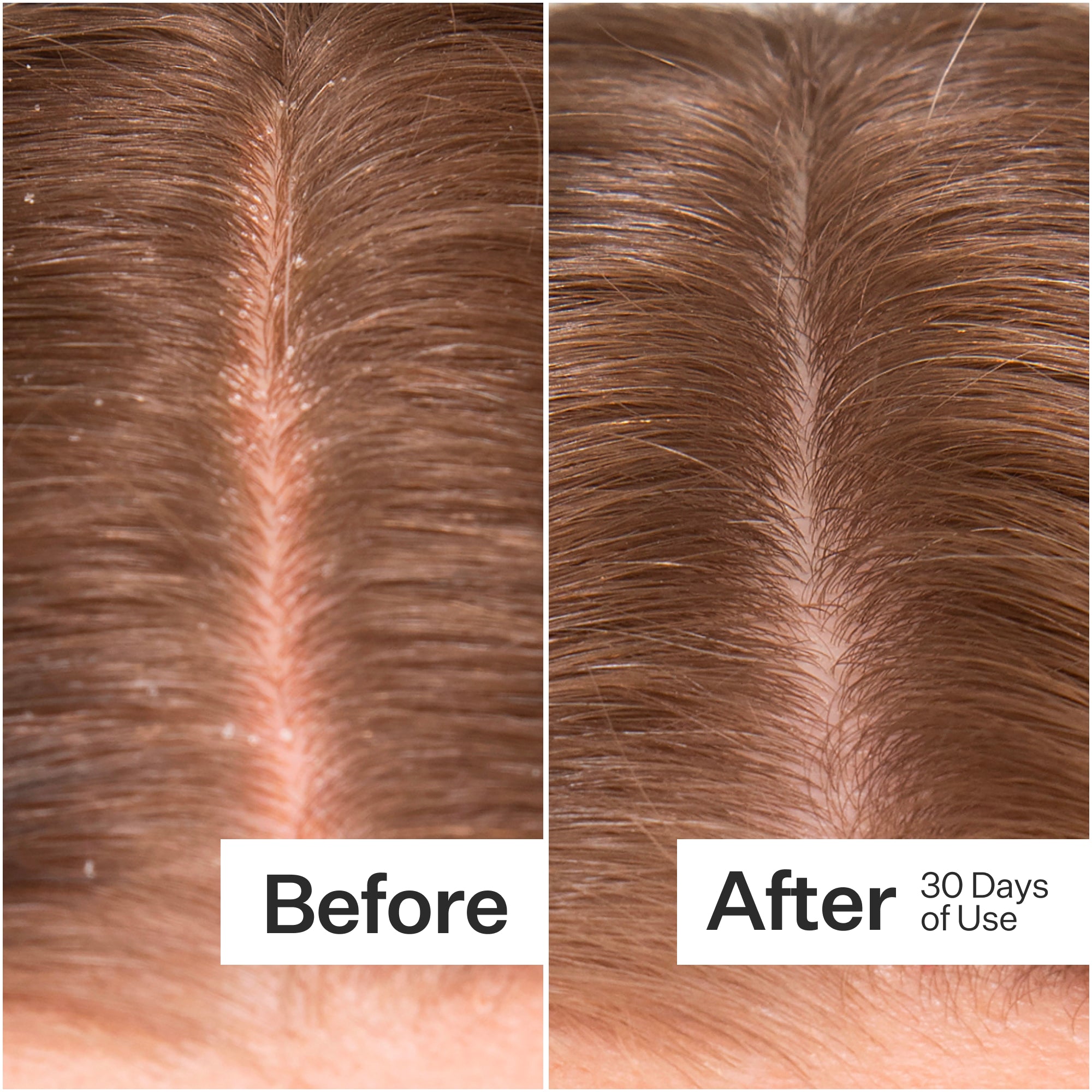 Side-by-side comparison of hair before and after 30 days of use, showing improved scalp condition and reduced flakes.