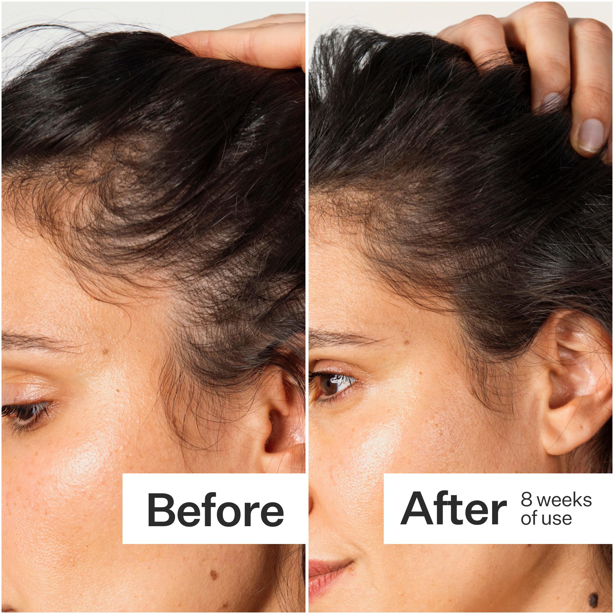 Side-by-side comparison of a woman's hairline before and after 8 weeks of use, showing noticeable improvement in hair density.