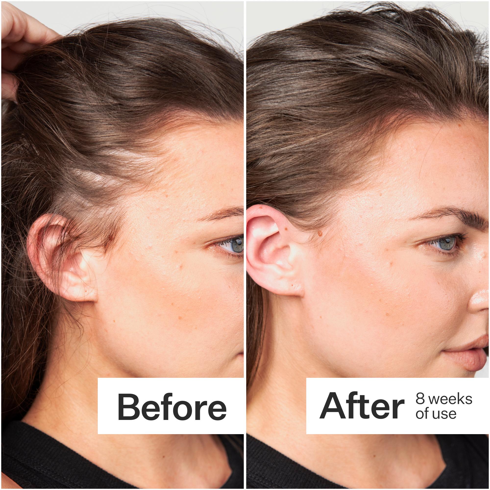 Side-by-side comparison of a woman's hairline before and after 8 weeks of use, showing noticeable improvement.