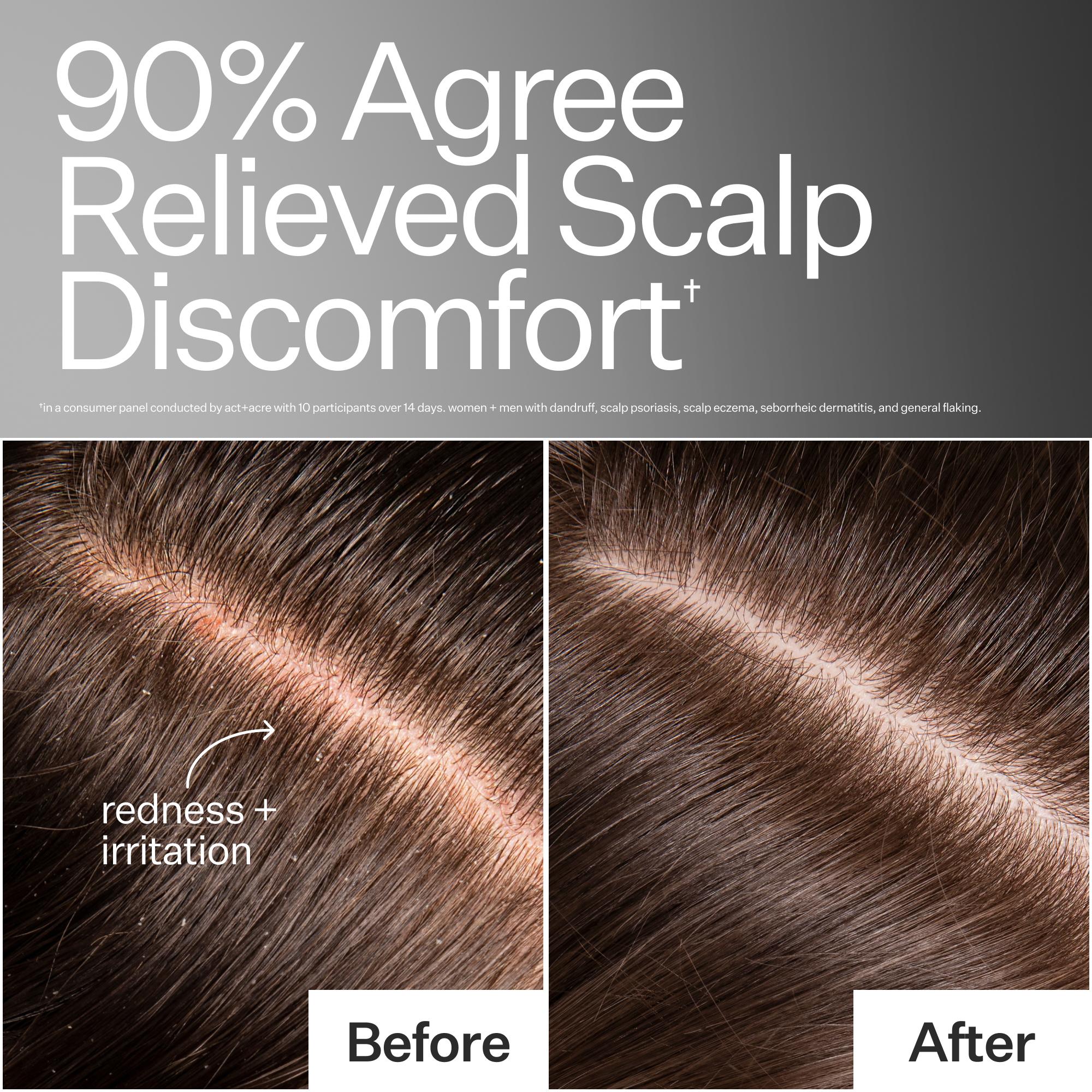 Before and after comparison of scalp with redness and irritation, showing relief from scalp discomfort.
