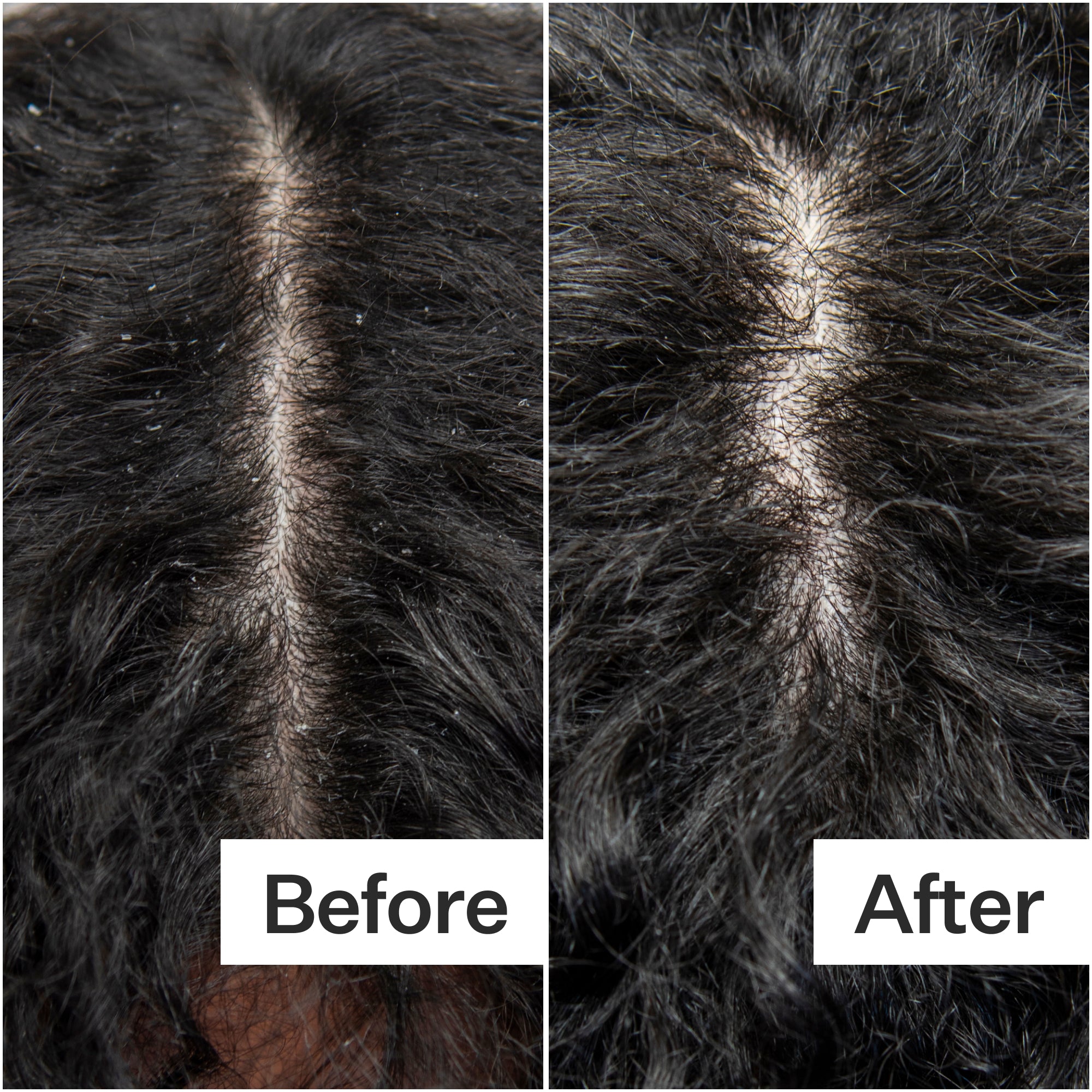 Side-by-side comparison of a scalp showing dandruff before treatment and a clearer, healthier appearance after treatment.