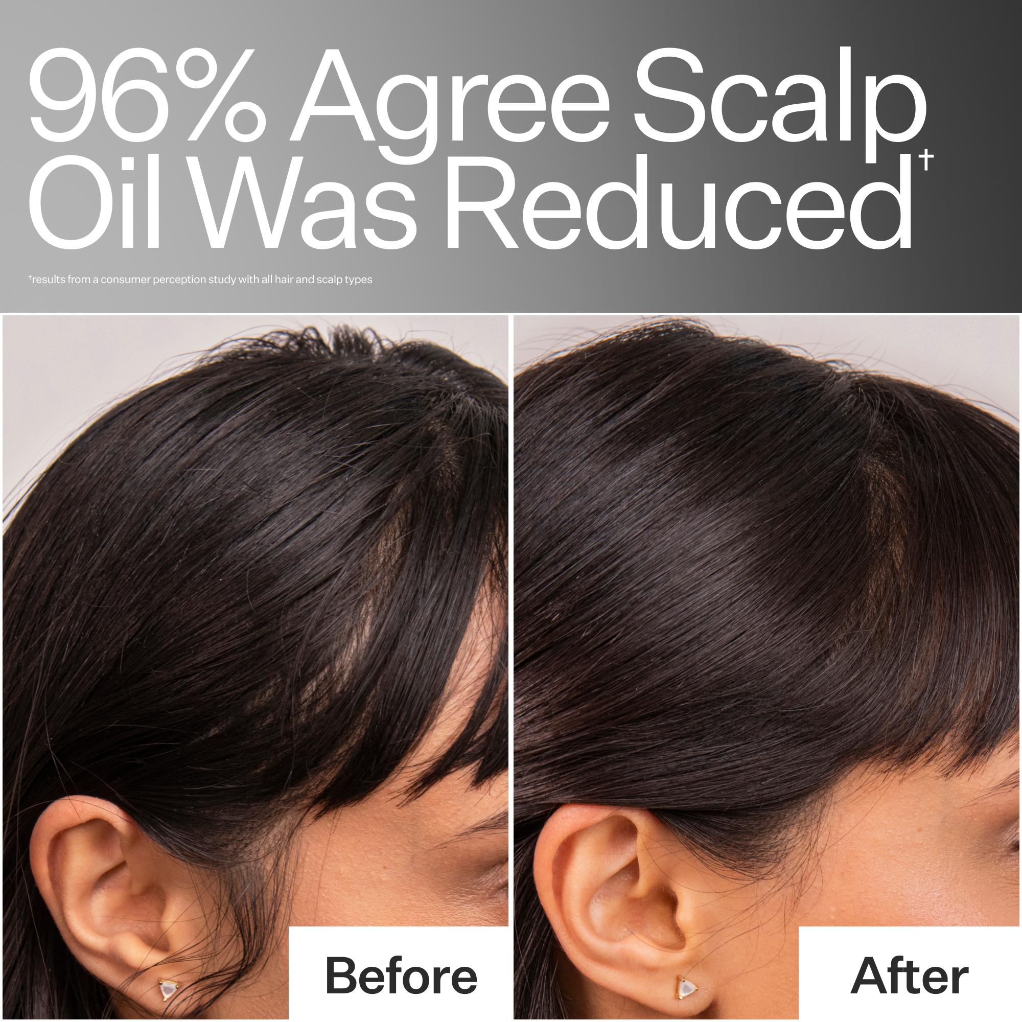 Before and after comparison of scalp oil reduction with text '96% Agree Scalp Oil Was Reduced'.
