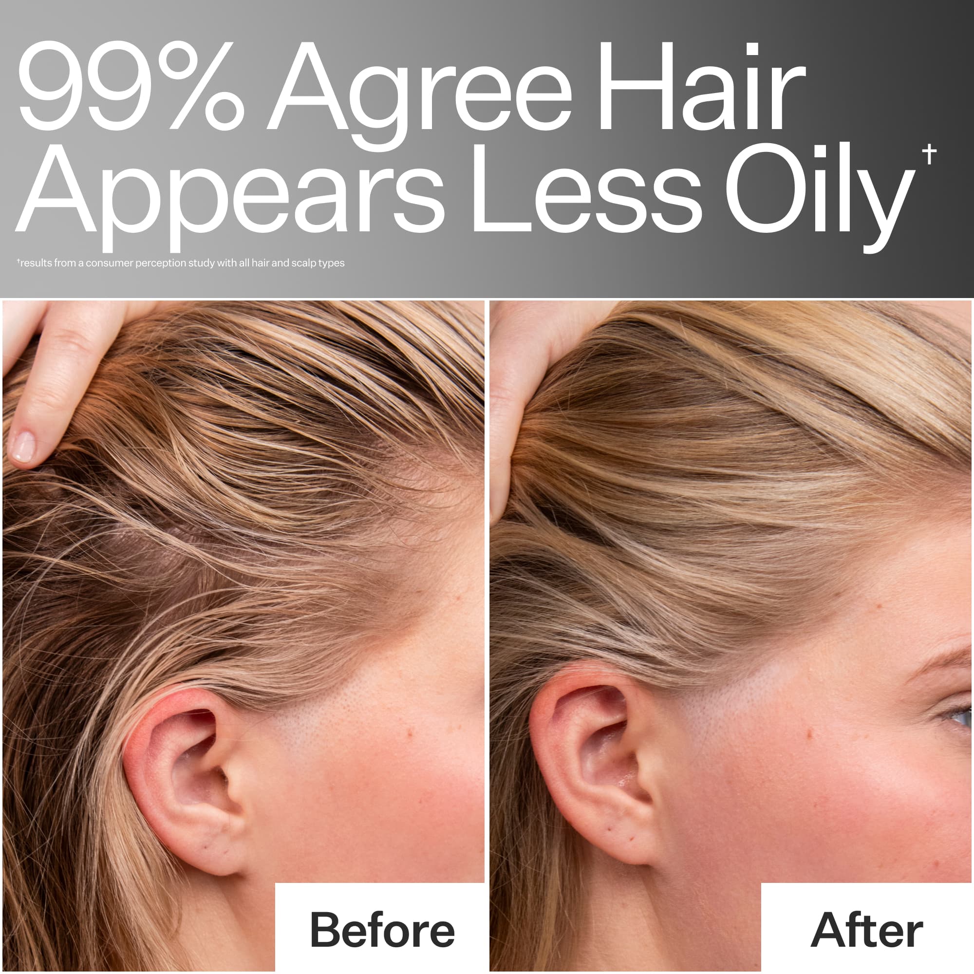 Before/After when using Act+Acre 4% Niacinamide Oily Scalp Serum
