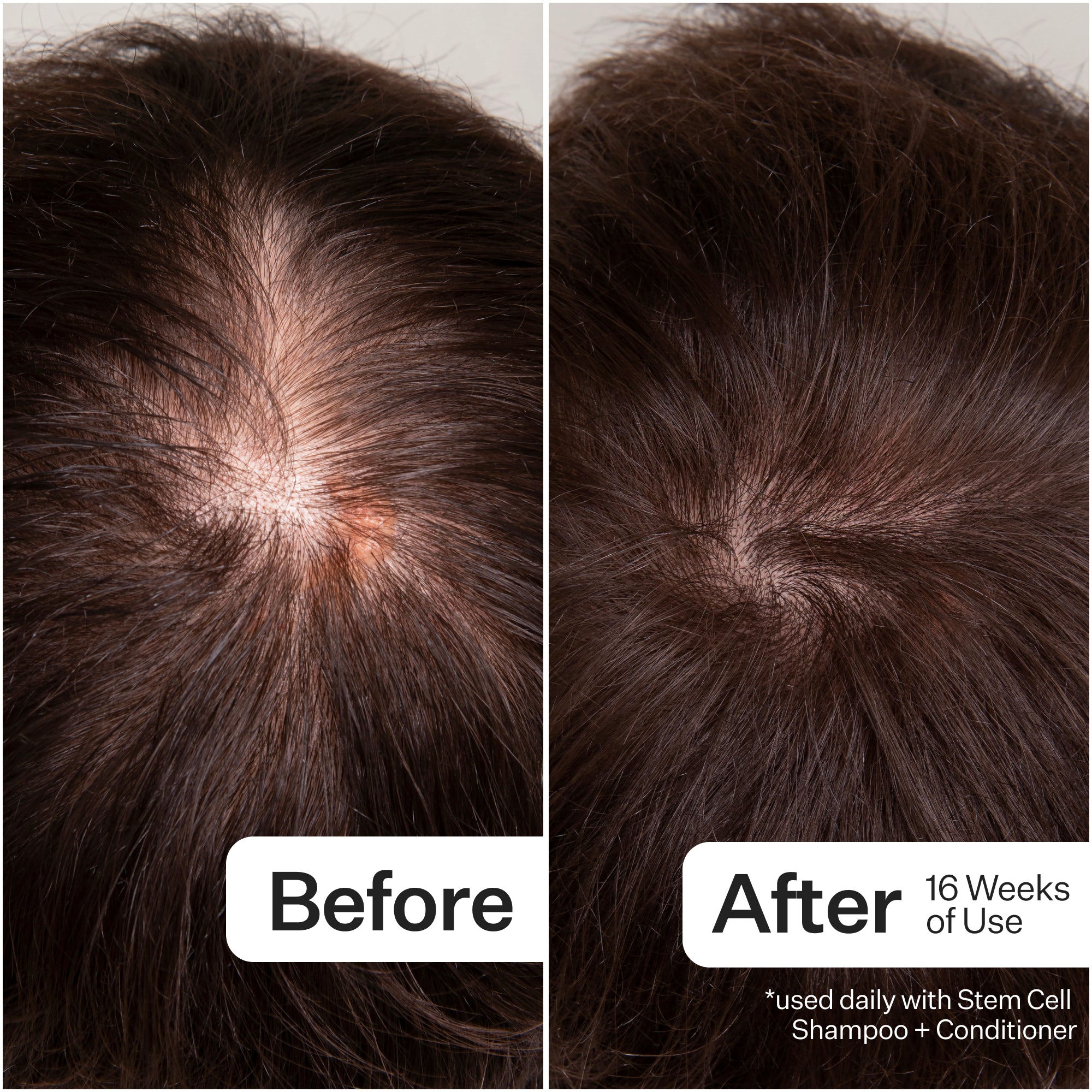 Side-by-side comparison of a scalp showing hair improvement after 16 weeks of using Stem Cell Shampoo and Conditioner.