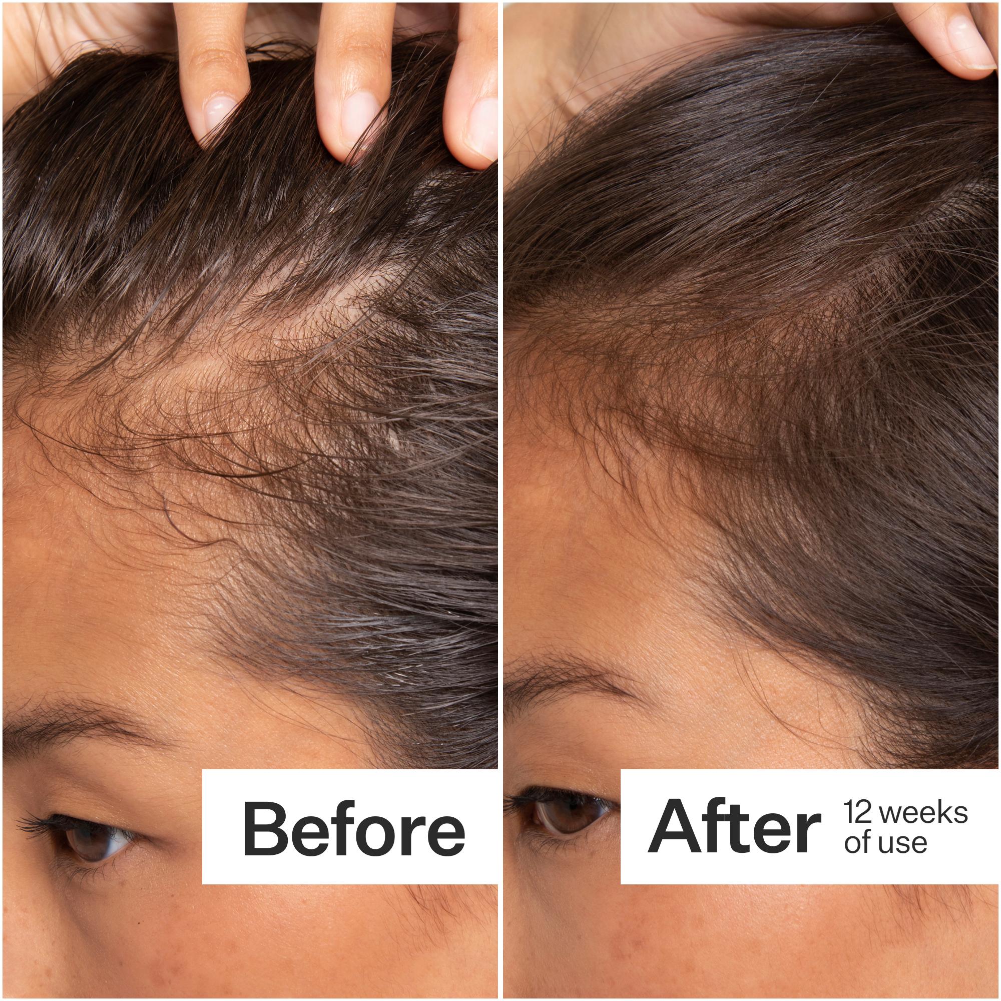 Side-by-side comparison of hairline before and after 12 weeks of use, showing noticeable improvement in hair growth.