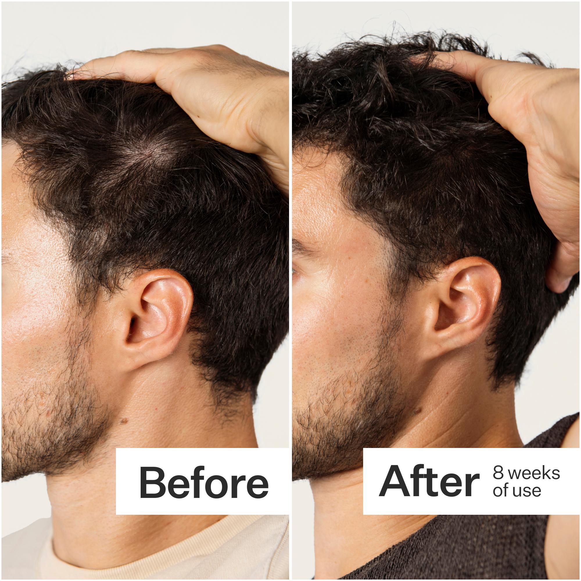 Side-by-side comparison of a man's hair before and after 8 weeks of use, showing noticeable improvement in thickness and coverage.