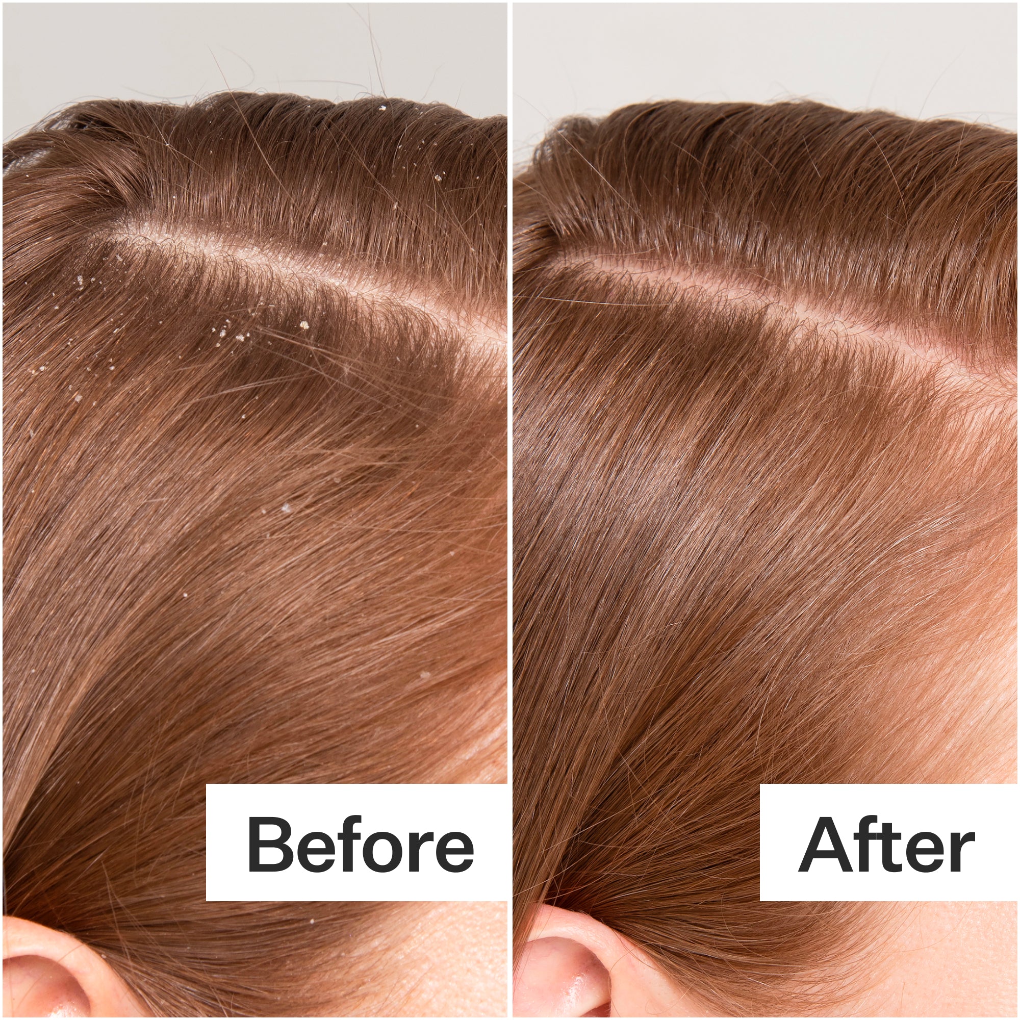 A side-by-side comparison of hair showing dandruff in the "Before" image and a clean, dandruff-free look in the "After" image.