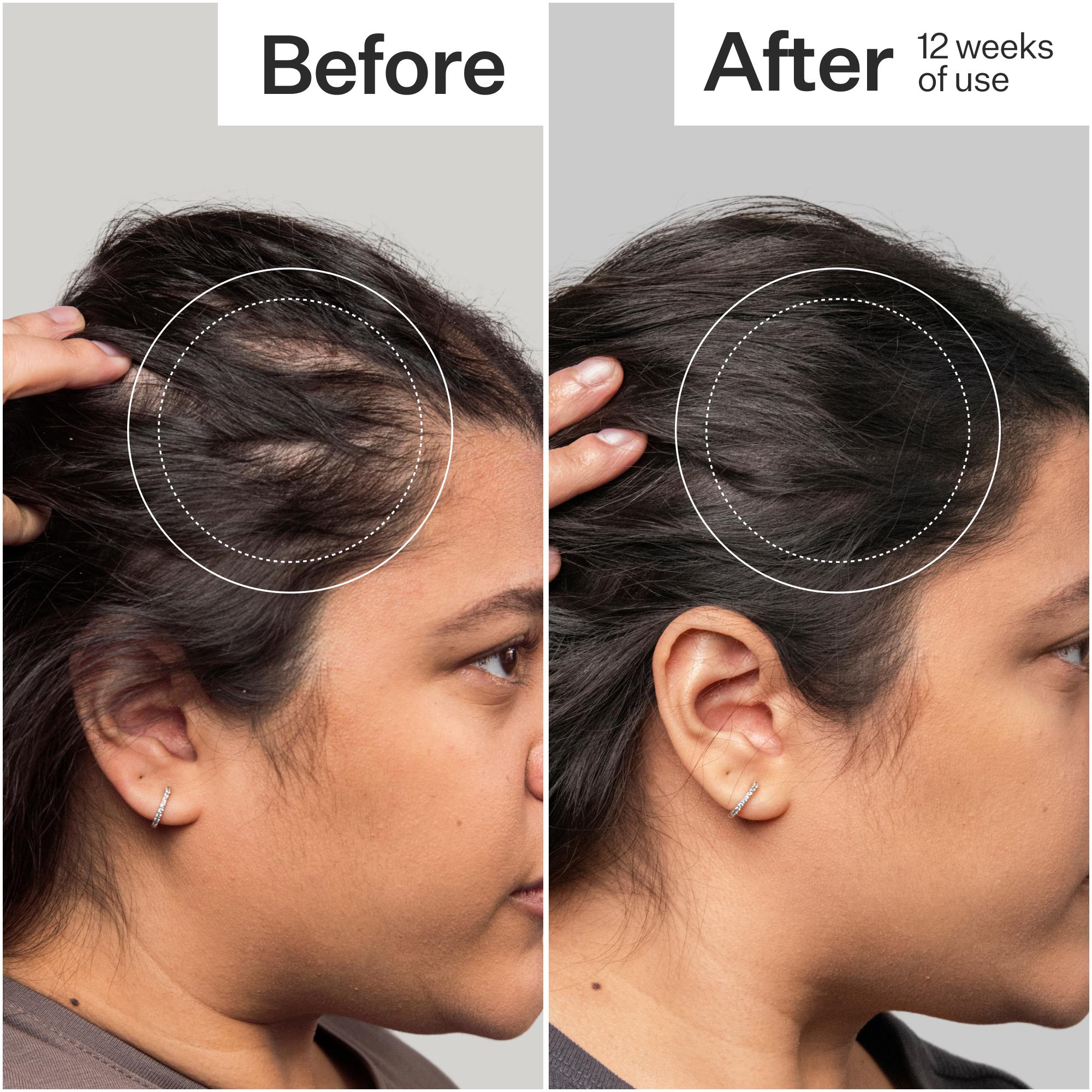 Before and after comparison of hair thickness on a person's head, showing an increase in thickness over 12 weeks.