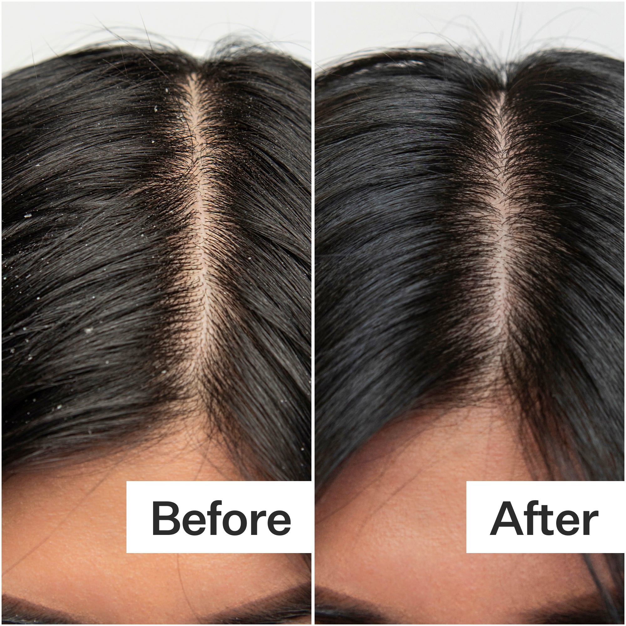 Side-by-side comparison of a scalp showing dandruff before treatment and a clean scalp after treatment.